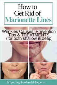 marionette lines what are they causes