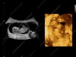 Learn about baby's heart development and about symptoms at 5 weeks pregnant. 12 Week Old Triplet Foetuses Ultrasound Scans Stock Video Clip K007 0321 Science Photo Library