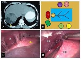 The gharbi ultrasound classification consists of five stages 4: Cureus Feasibility Of Laparoscopic Closed Cystectomy For Hepatic Hydatid Cyst In Segments Vi Vii And Viii