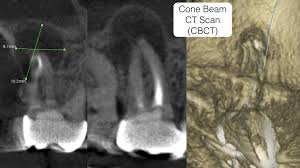 why cone beam ct scan cbct is a must