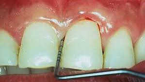 effective periodontal charting leads to