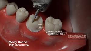 Pfm Crown Prep And Animation For Dental Students