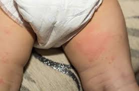baby rash a visual guide to skin