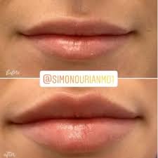 lip augmentation by kylie