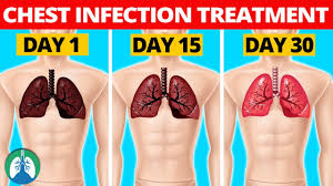 7 natural chest infection treatments