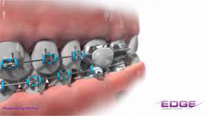 How do you remove wax from braces? How Do I Use That Braces Wax Salem Pediatric Dental