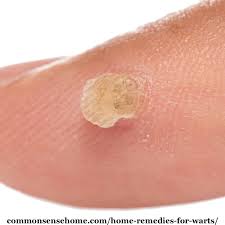 Often times, it resembles a callous or a small patch of rough hardened. 15 Home Remedies For Warts Easy Home Wart Treatments