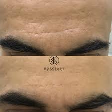 scar camouflage scar removal and scar