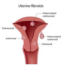 Uterus Fibroid Size Chart Bedowntowndaytona Com