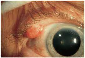 benign tumors of the eyelid epidermis