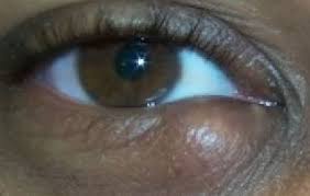 eye cyst chalazion cal