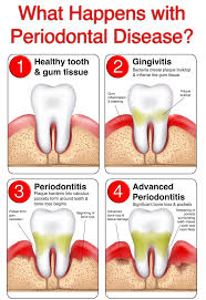 gum disease symptoms and treatment