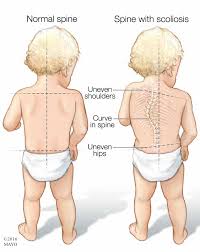 a cal ilration of a child with a normal spine and one with scoliosis