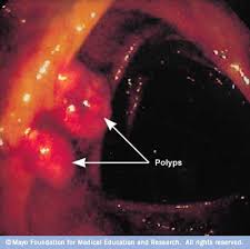 Colon Polyps Symptoms And Causes Mayo Clinic