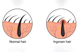 طرق إزالة الشعر تحت الجلد - عيادات ميدكا للجلدية والتجميل