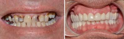 Bọc răng sứ trước và sau khi đã xong