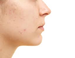 acne scarring 4 therapies for improvement