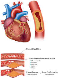coronary artery disease elite