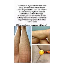 Laser removal done by a. Ideal Laser Hair Removal Cheaper Than Retail Price Buy Clothing Accessories And Lifestyle Products For Women Men