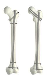 t2 alpha antegrade femur stryker