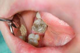 how to fix rotting teeth and 5 best
