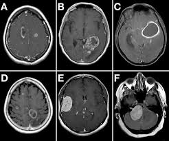 Ms disrupts the ways that your ne. Tumefactive Multiple Sclerosis Radiology Reference Article Radiopaedia Org