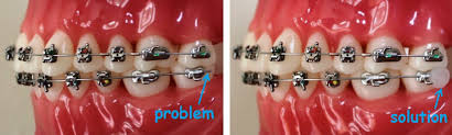 an orthodontic emergency