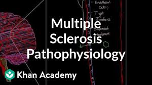 Multiple Sclerosis Pathophysiology Video Khan Academy