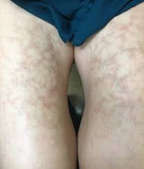 reticulated rash on inner thigh