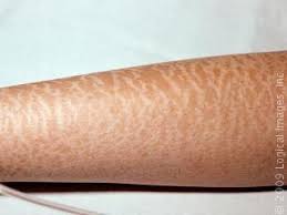 Image result for masalah kulit badan
