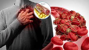 10 Foods That Can Prevent Clogged Arteries