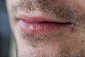 cold sores treatment