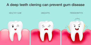 teeth deep cleaning everything you