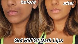 get rid of dark lips and pigmentation