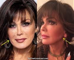 marie osmond plastic surgery comparison