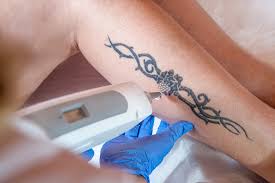 a tattoo removal
