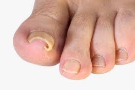 curly toenails what they indicate and