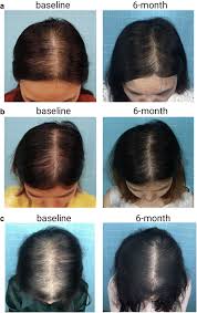 treatment of female pattern hair loss