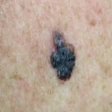 Melanoma is, in simple terms, skin cancer. Melanoma Pictures Example Pictures Of Melanoma Symptoms