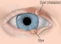 eyelid cyst article by dr ashley roth
