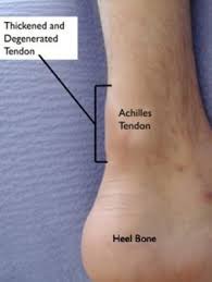 What can this be? answered by dr. Achilles Tendinitis Orthoinfo Aaos