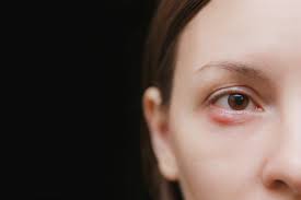 eye infections conjunctivitis stye