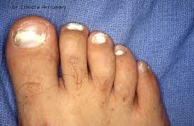 a guide to toenail fungus types of