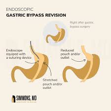 endoscopic bariatric revision