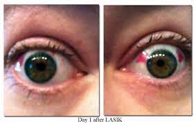 my lasik eye surgery experience the