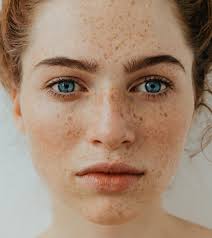 12 home remes for freckles on face