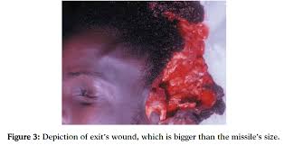 I have never heard of such an incident. Wound Ballistic Mechanisms Caused By Missile Entrance In Human Body Cranium Insight Medical Publishing