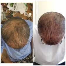 But there are some promising revelations surrounding the idea of using cbd for hair loss and there's some additional facts we do know for sure. Cbd And Hair Growth Follow Up 2 Months Of Using Cbd Oil On My Hair Daily Cbd Seems To Be Working Cbd