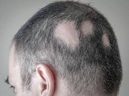 ps on the scalp causes symptoms