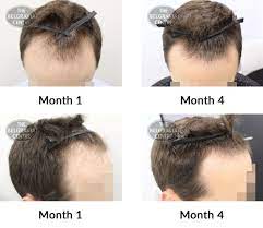More than half of women will experience genetic hair loss (female pattern baldness) before the age of. Hair Growth Success Story Best Decision Made This Year So Far